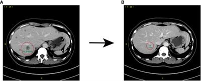 Disitamab Vedotin (RC48) combined with bevacizumab for treatment of HR-negative/HER2-positive metastatic breast cancer with liver and brain involvement: A case report